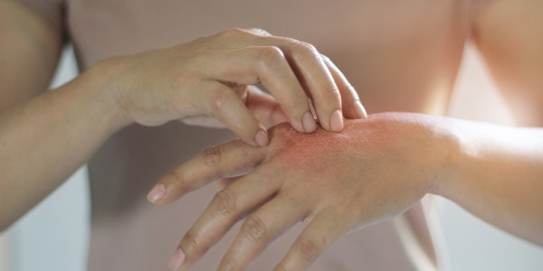 neurodermitis-symptome-ausschlag-hand